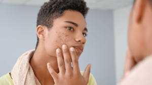 Young man with acne looking at his face in the mirror