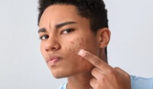 African-American Teenage Boy Applying Remedy for Acne
