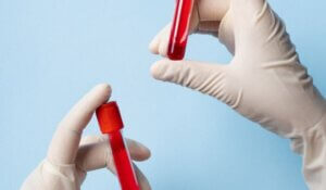 Symptoms of hemophilia