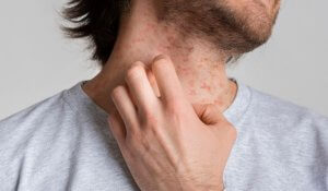 Psoriasis can cause itching, especially when it affects the scalp.