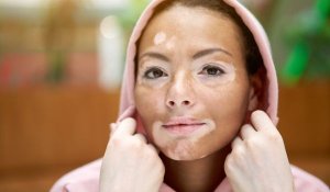 hyperpigmentation in kids