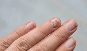 finger nails showing signs
