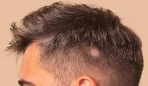 Understanding treatments for severe alopecia: A comparative look at options