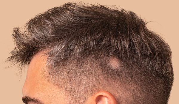 Understanding treatments for severe alopecia: A comparative look at options